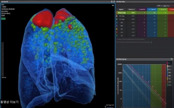 3D 영상 의료AI 기업 '코오라인소프트' 상장 예심통과 ... 스팩합병 '잰걸음'