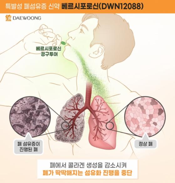 대웅제약 '폐섬유증 후보물질', 유럽서도 희귀의약품 지정…10년 독점권 등 혜택